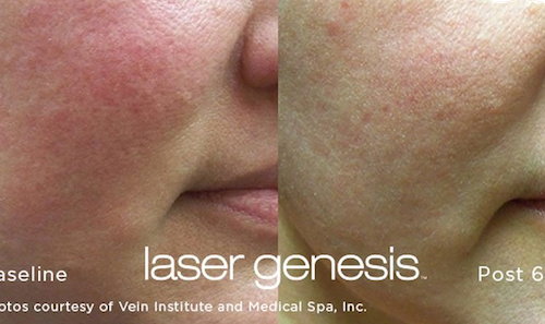 Facial redness treatment before after mississauga oakville